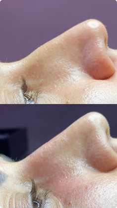botox_preenchimento_labial_01_1x