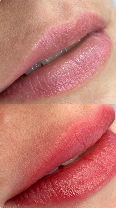 botox_preenchimento_labial_02_1x