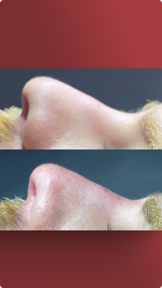 botox_preenchimento_labial_03_1x