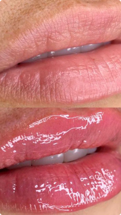 botox_preenchimento_labial_04_1x