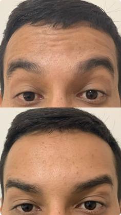 botox_preenchimento_labial_05_1x