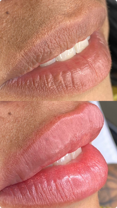 botox_preenchimento_labial_06_1x