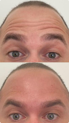 botox_preenchimento_labial_07_1x