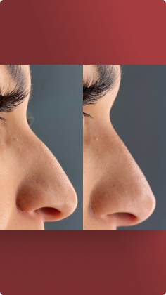 botox_preenchimento_labial_08_1x