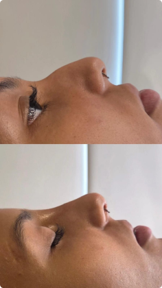 botox_preenchimento_labial_09_1x