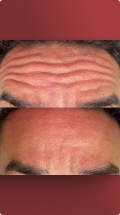 botox_preenchimento_labial_10_1x