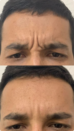 botox_preenchimento_labial_11_1x