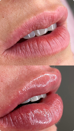 botox_preenchimento_labial_12_1x